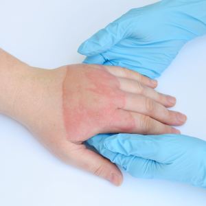 Burns Treatment Near Me in Canton and Acton, MA