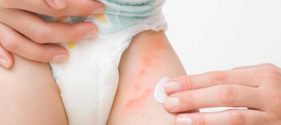 Diaper Rash Treatment Clinic Near Me in Canton, MA Diaper Rash Treatment Clinic Near Me in Canton, MA