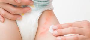 Diaper Rash Treatment Clinic Near Me in Canton, MA Diaper Rash Treatment Clinic Near Me in Canton, MA