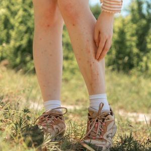 Insect and Sting Bites Treatment Near Me in Canton and Acton, MA