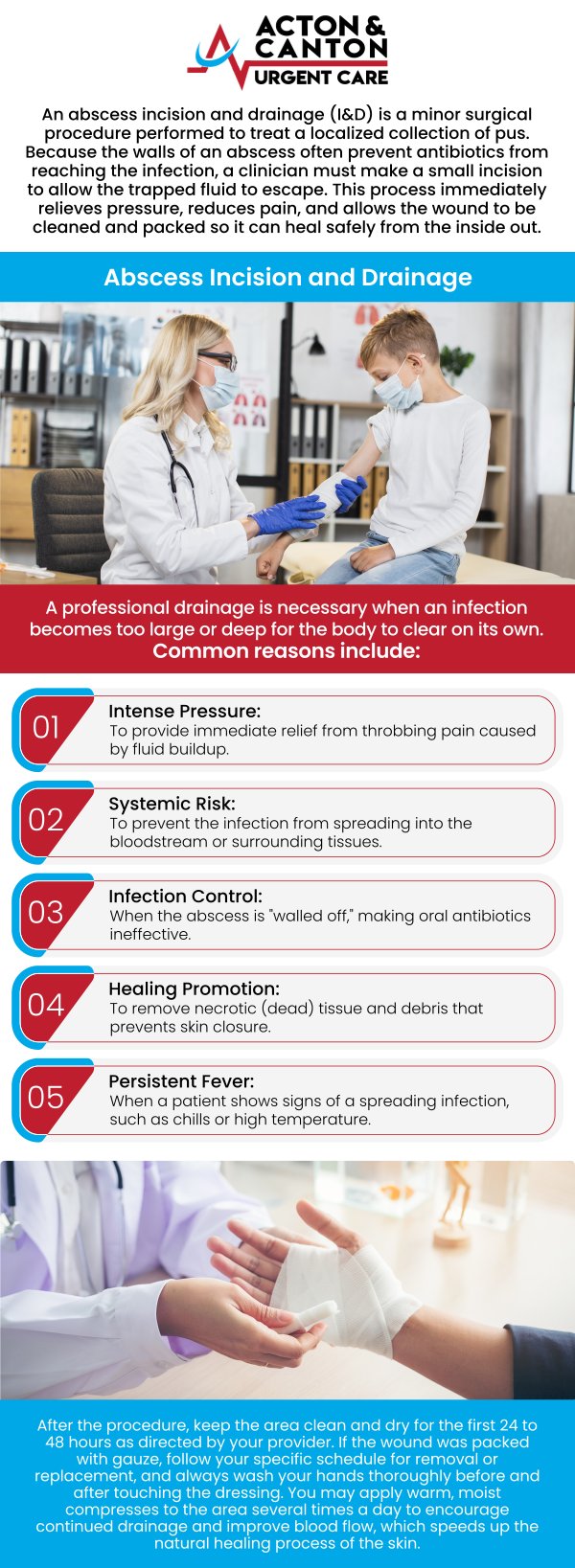 If you are wondering where to find reliable abscess treatment in Canton, MA, visit our dedicated medical staff at Canton Urgent Care. An abscess requires more than just a quick fix; it demands a sterile procedure and professional follow-up to ensure the infection is fully eradicated. Our team of experienced professionals is equipped to handle the entire process—from the initial assessment and numbing to the precise incision and drainage (I&D) required to relieve pressure and pain immediately. For more information, contact us or schedule an appointment online. We are located at 95 Washington St, Ste 204 A, Canton, MA 02021.