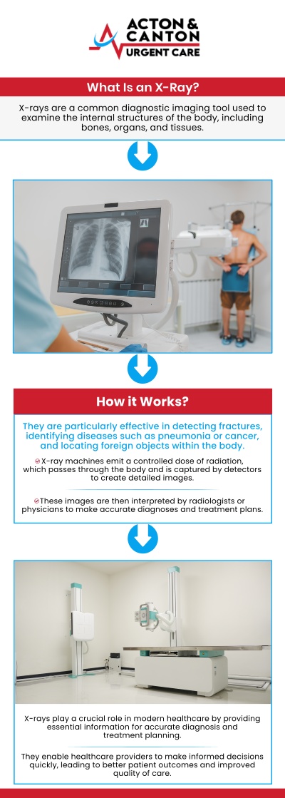 At its core, an X-ray is a quick, painless imaging test that uses a small amount of radiation to create pictures of the structures inside your body—particularly your bones. For patients at Acton Urgent Care, this technology is often the first line of defense in medical problem-solving. Our team of skilled professionals uses X-rays to see through soft tissue, capturing the dense structures beneath. For more information, contact us or schedule an appointment online. We are located at 100 Powder Mill Rd, Acton, MA 01720.